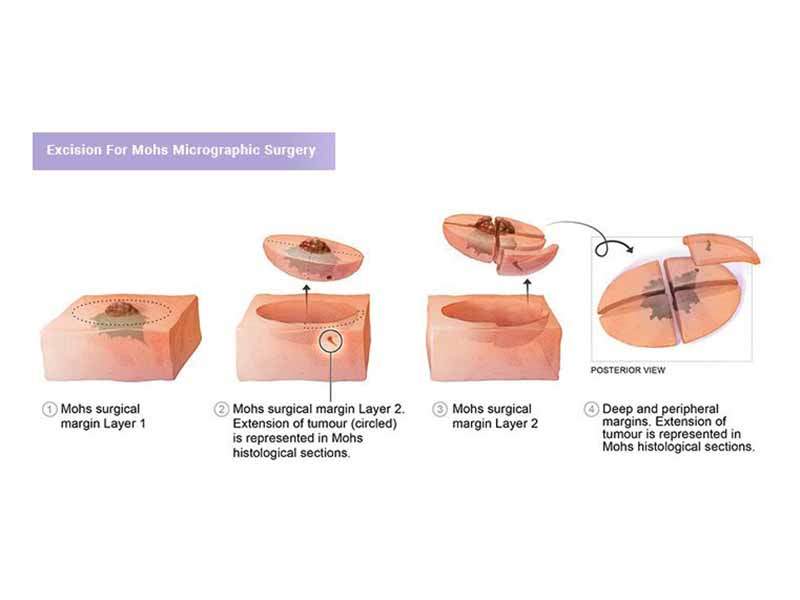 Excision For Mohs Micrographic Surgery explained