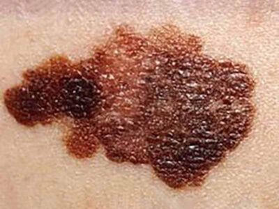 Melanoma mole ready for skin cancer treatment