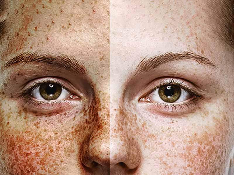 Skin Cancer Treatment Center Best in South Florida